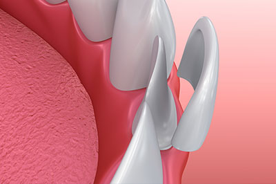 Katherine Hall DDS | Digital Radiography, Veneers and Snoring Appliances