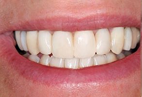 Katherine Hall DDS | Dental Bridges, Dentures and Cracked Teeth