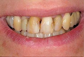 Katherine Hall DDS | Root Canals, Ceramic Crowns and Preventative Program